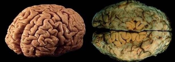 il cervello di una persona sana e bevitrice